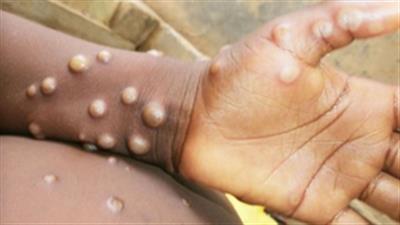 Africa CDC warns of rising mpox cases, launches response plan with WHO